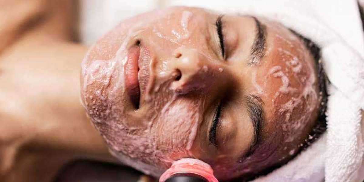 Get Herbal Green Peel at Revive Beauty Solutions